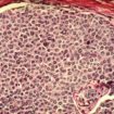 Breast_cancer_cells